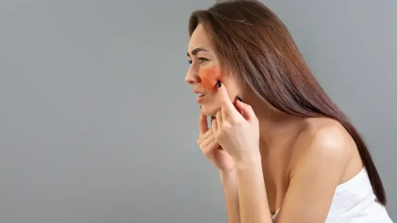 Co warto wiedzieć o hiperpigmentacji skóry